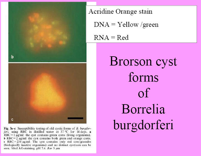 Brorson-Borrfelia-cyst-Acridine-orange