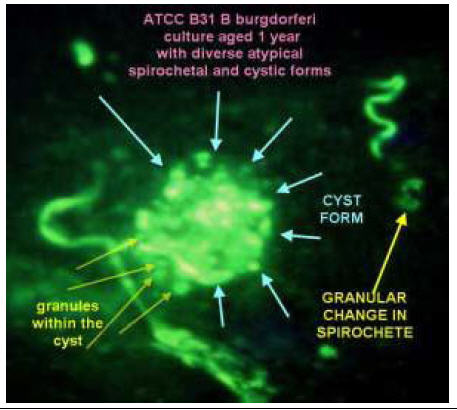 Cysts, Granular forms and corkscrew forms are examples of a spirochetal life cycle