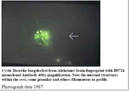 Cystic borrelia in Alzheimer Autopsy Brain tissues