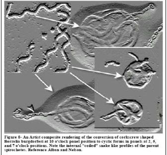 Cystic Borrelia - Compare Dr Brorson's Cyst forms with internal Filaments with Drs Alban and Nelson's 