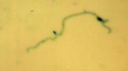 Non coiled and Straightened borrelia in Fetal Brain in Sudden  Infant Death Syndrome SIDS