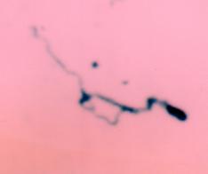 Spirochete stained with Silver from Brain of baby who Died from SIDS - Sudden Infant death Syndrome